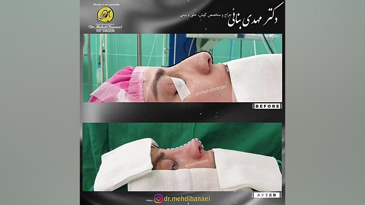 سه ماه بعد از عمل زیبایی بینی
