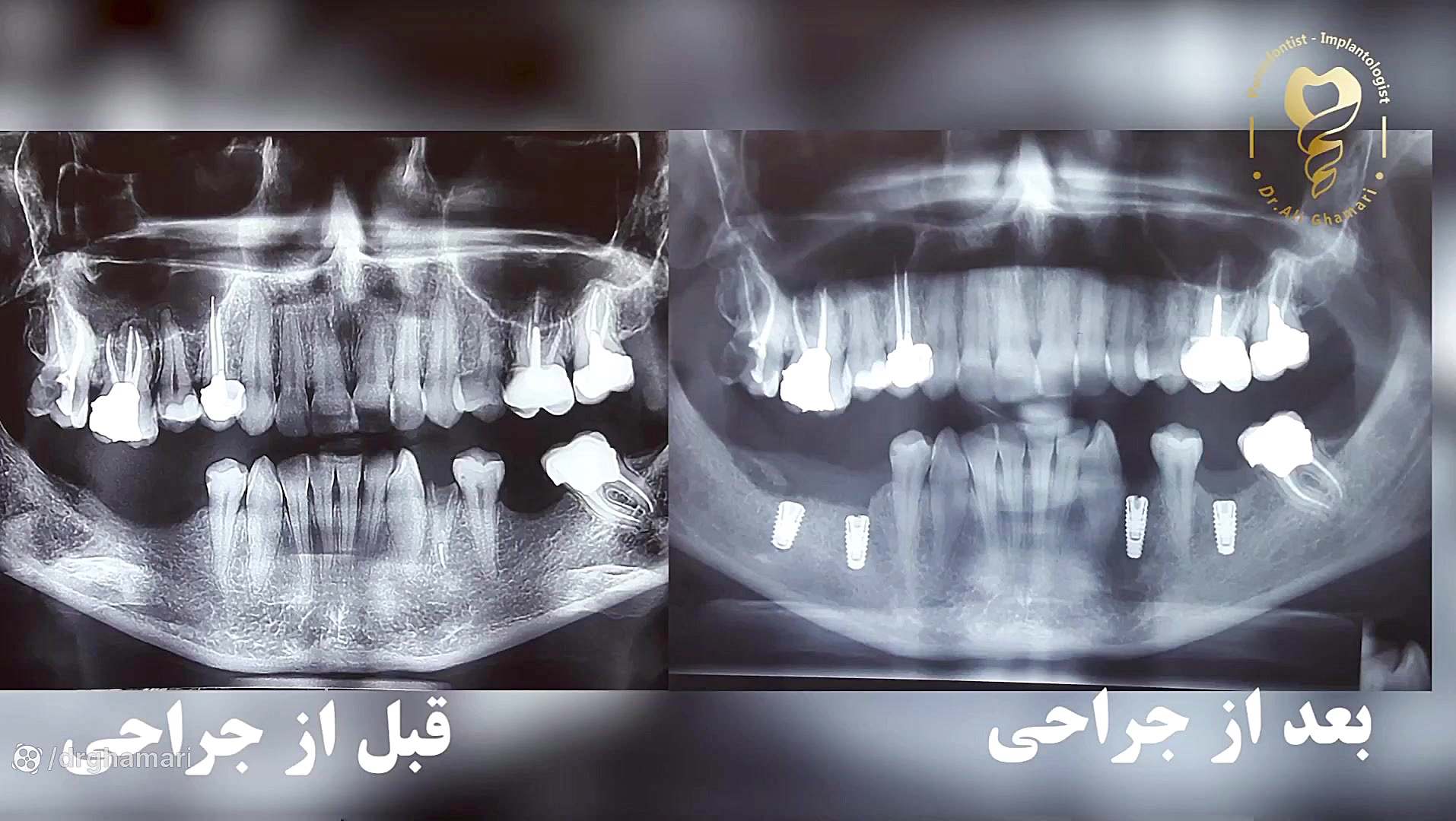 جراحی ایمپلنت ۴ واحد فک پایین دکتر علی قمری - متخصص جراحی لثه و ایمپلنت