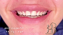 کامپوزیت دندان
