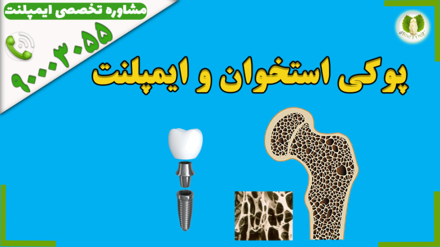 ایمپلنت و پوکی استخوان آکنه