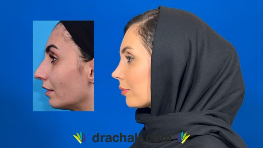 عمل زیبایی بینی | دکتر فرشید آچاک بیماری دیستروفی لیمب-گیرل