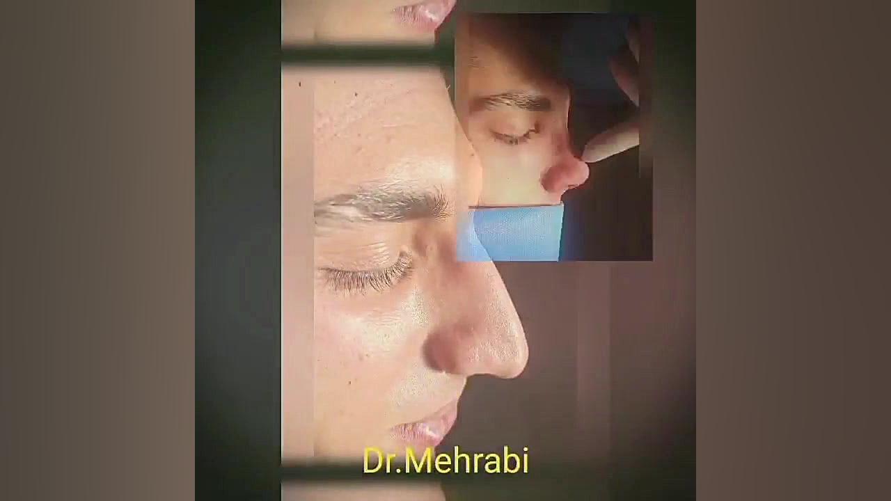 جراحی بینی گوشتی در شیراز دکتر محمد مهدی مهرابی جراح پلاستیک و زیبایی