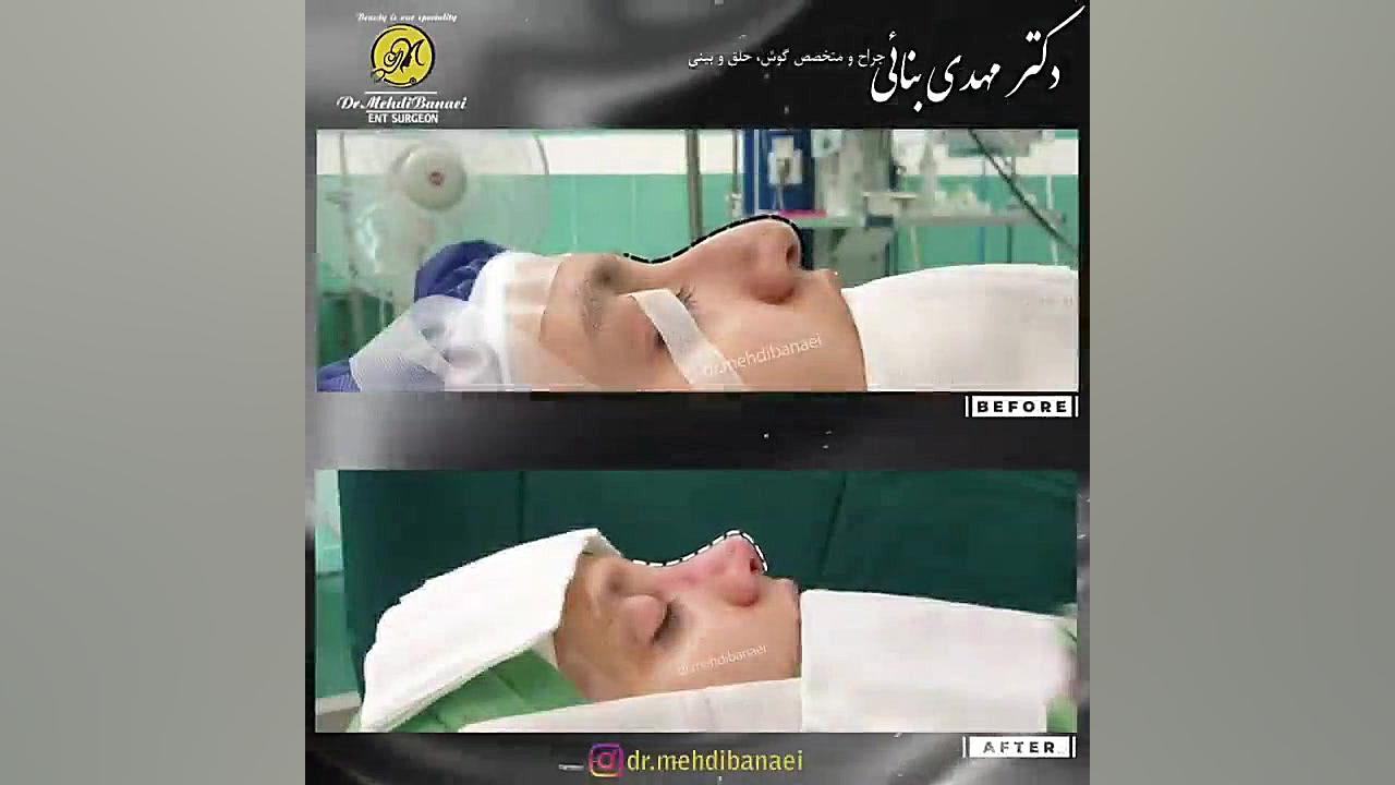 جراحی بینی طبیعی