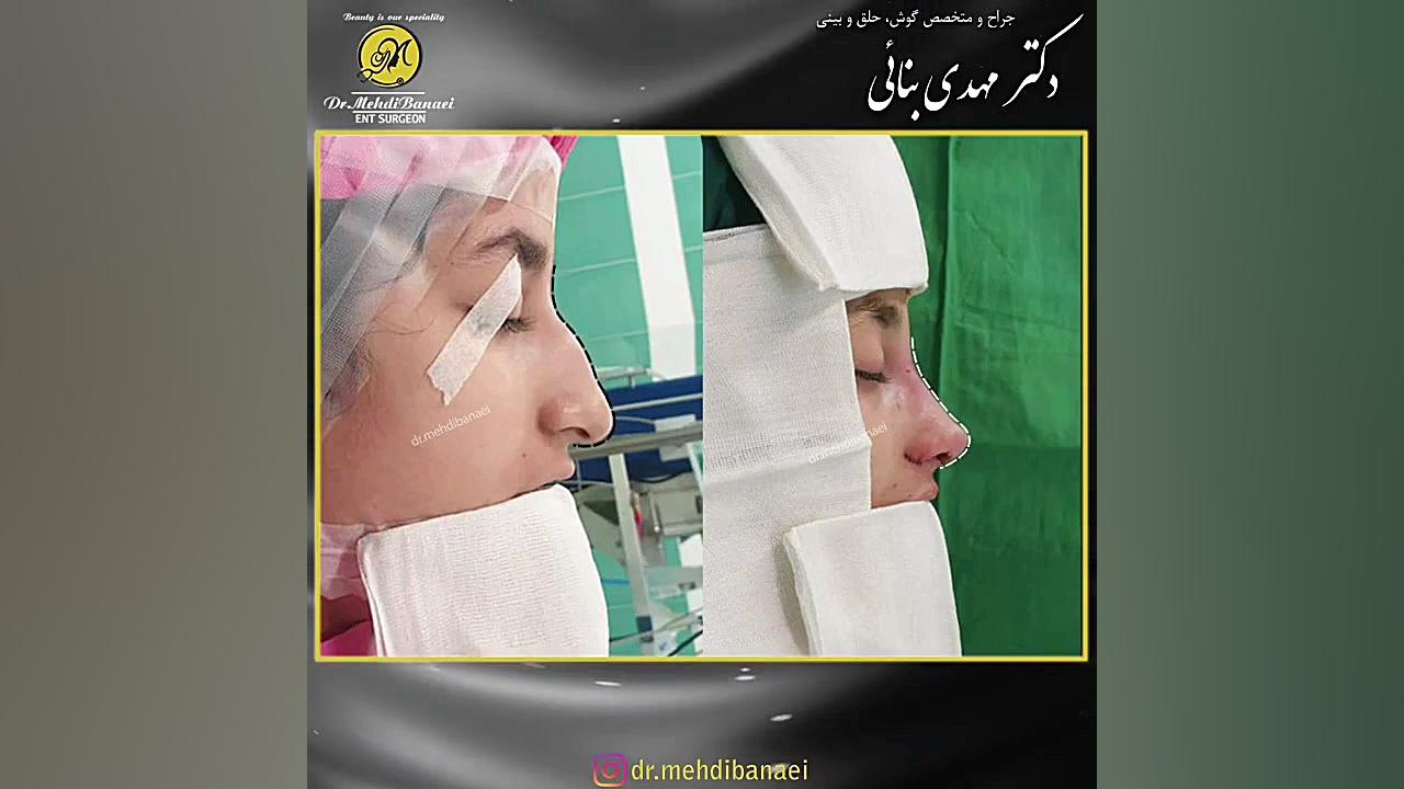 جراحی بینی با افتادگی بسیار شدید نوک بینی