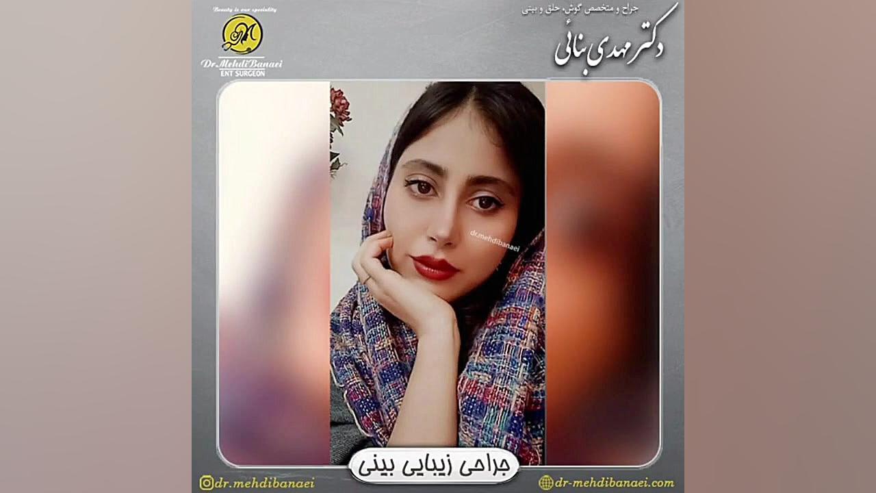 قبل و بعد از جراحی بینی با نوک گرد