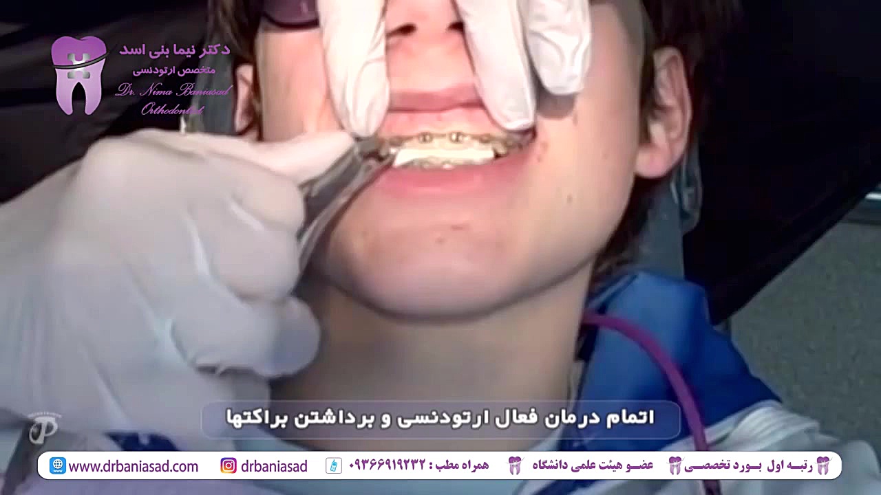 اتمام درمان ارتودنسی و برداشتن براکت ها - دکتر نیما بنی اسد دکتر نیما بنی اسد - متخصص ارتودنسی در تهران