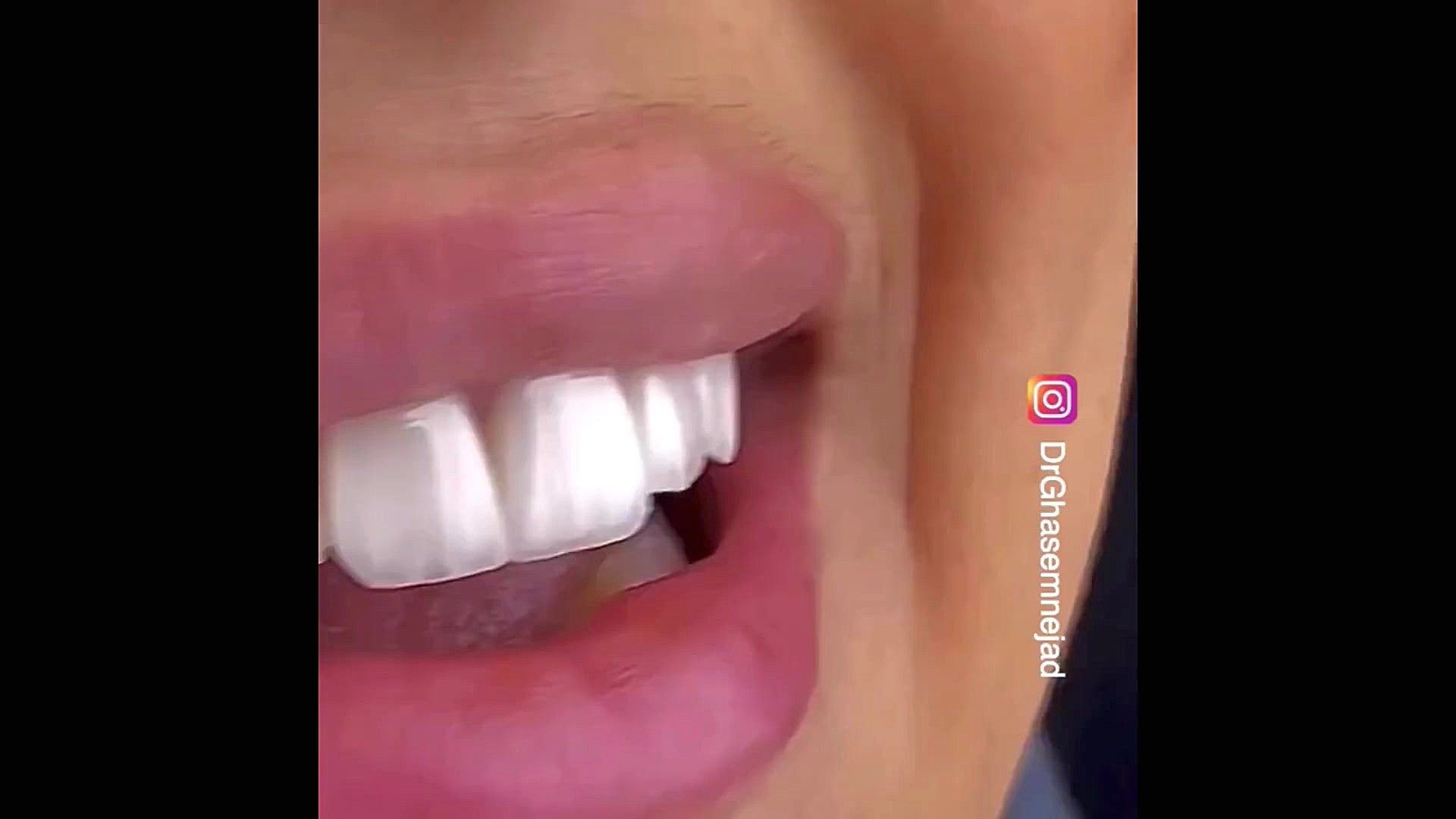 کامپوزیت لبه شیشه ای دندانپزشکی زیبایی دکتر قاسم نژاد