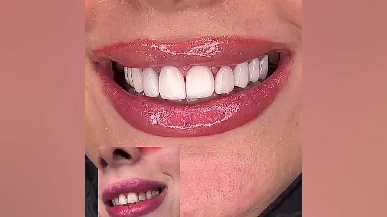 10 واحد لمینت سرامیک آی پی اس دندانپزشکی زیبایی دکتر قاسم نژاد