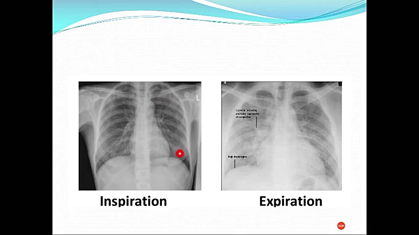 تفسیر رادیوگرافی و CT-Scan بیماری های ریوی اونپاترو