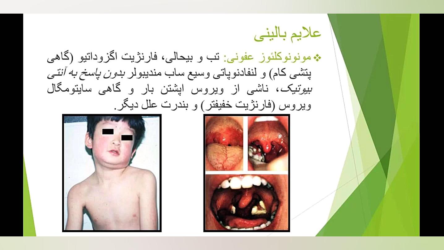 آقای دکتر هومان هاشمیان (فارنژیت) ترمیم ونیر