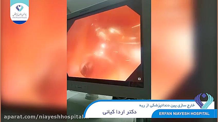 خروج پین دندانپزشکی از ریه بیمار دکتر اردا کیانی