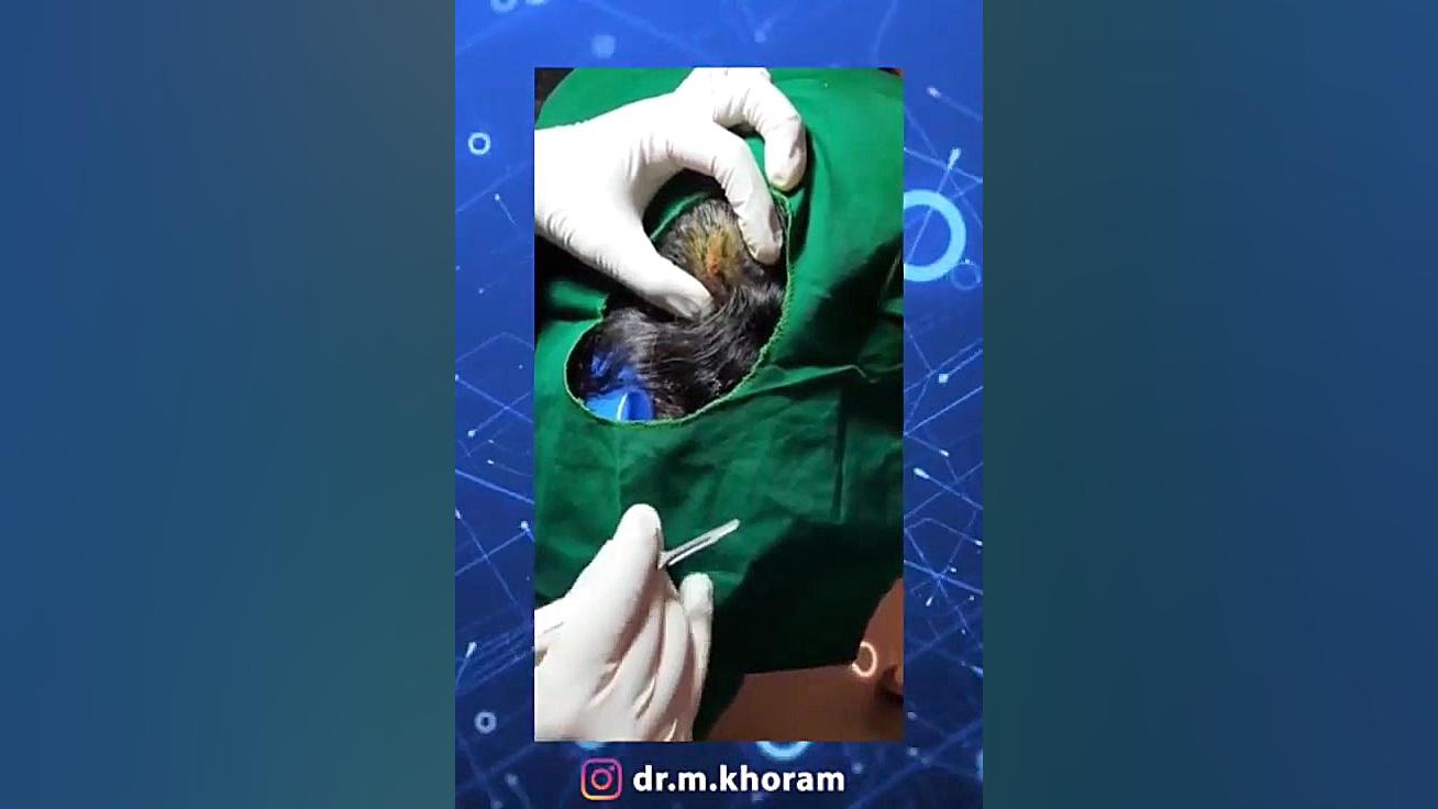 درمان توده سر دختر 18 ساله دکتر مهران خرم