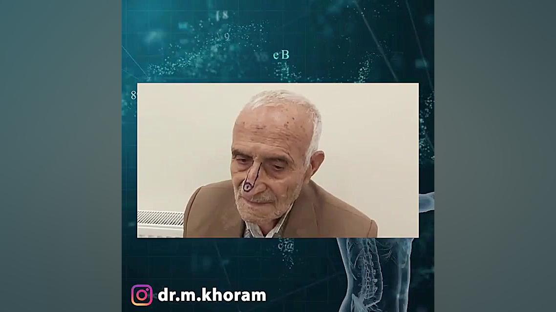 جراحی تومور بینی در سنین میانسالی دکتر مهران خرم