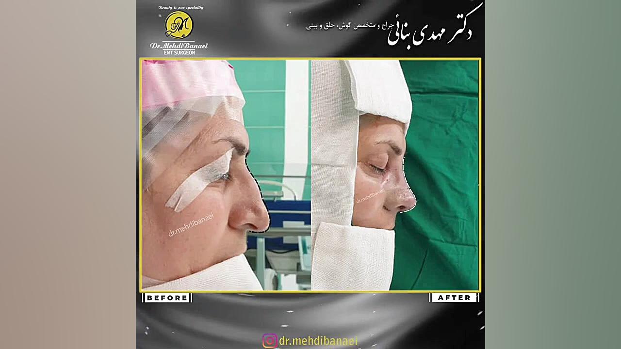 قبل و بعد از جراحی بینی با افتادگی نوک بینی