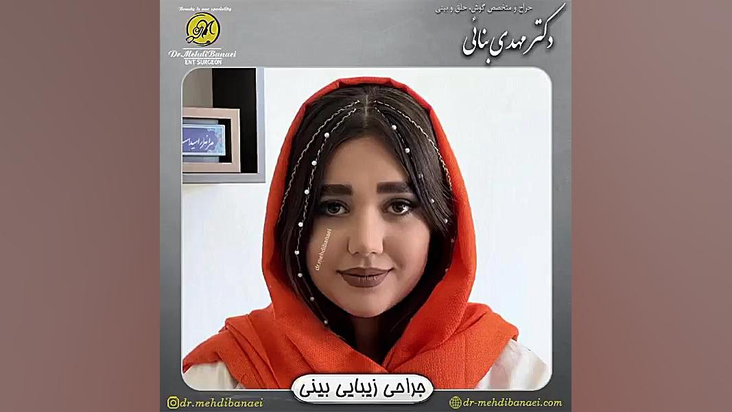 رضایت بیمار عزیز دو ماه پس از جراحی زیبایی بینی