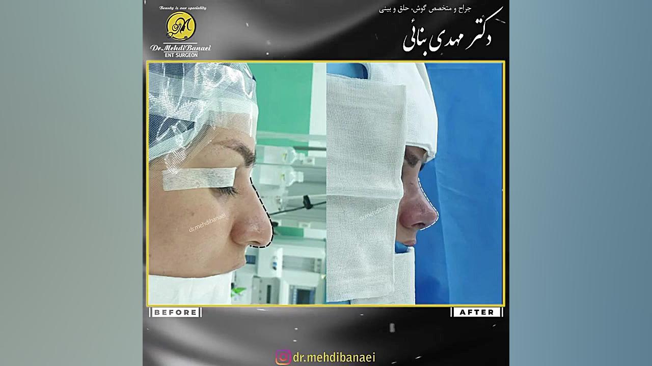 جراحی بینی گوشتی