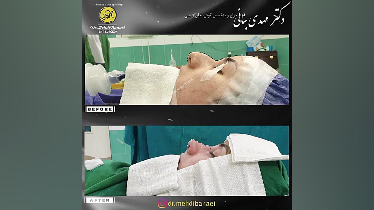 جراحی زیبایی بینی با قوز شدید