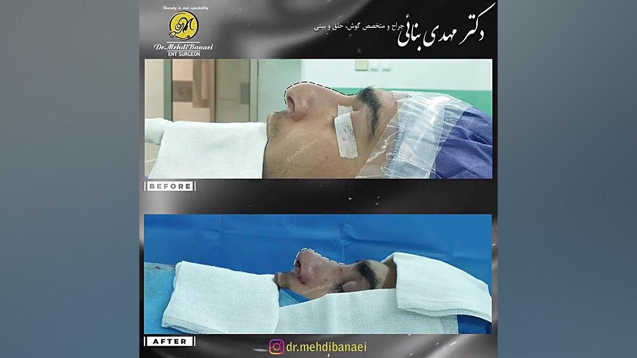 جراحی بینی مردانه با قوز شدید