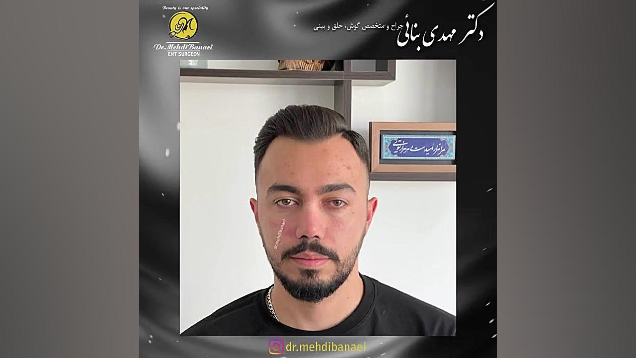 جراحی بینی طبیعی و مردانه