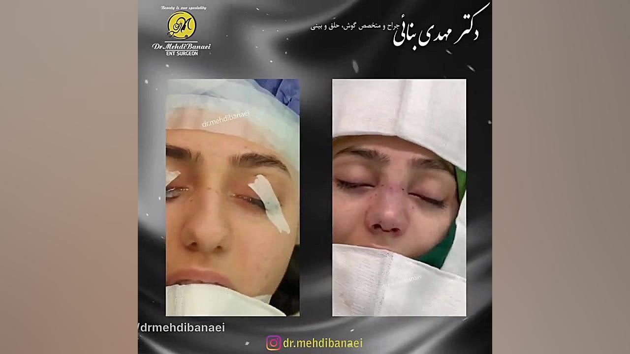 جراحی بینی گوشتی و قوزدار