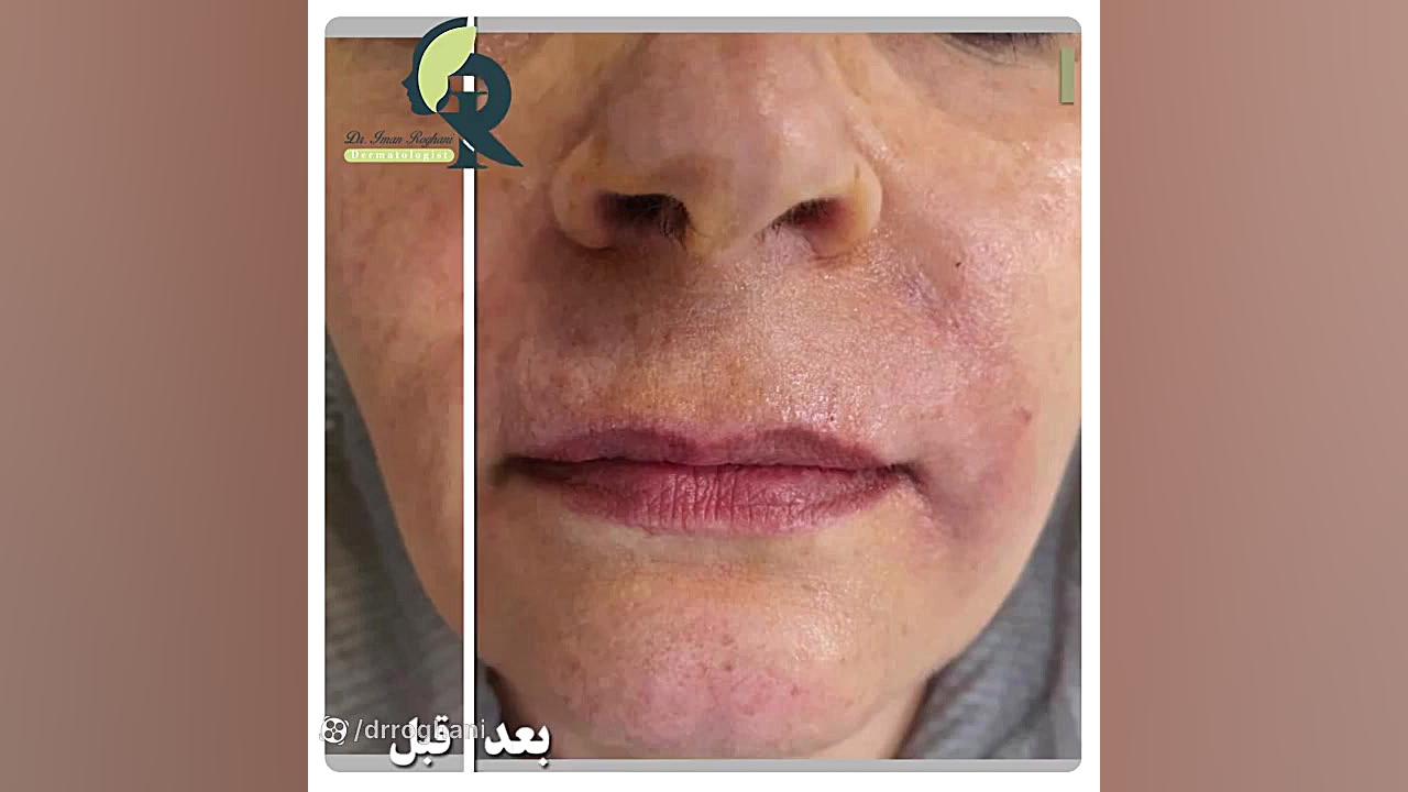 تزریق فیلر برای بهبودی خطوط دور دهان چین خنده و خط غم و خطوط ریز بالای لب دکتر ایمان روغنی جراح و متخصص پوست و مو