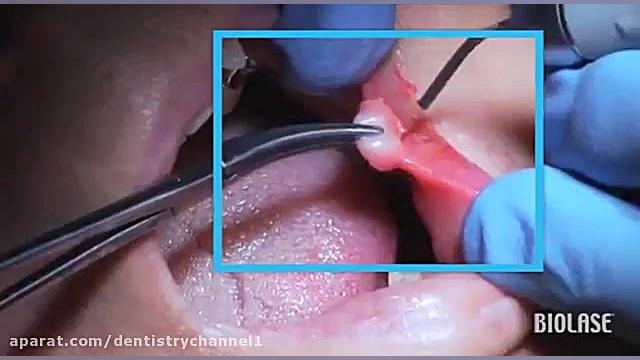 عمل جراحی برداشتن فیبروم لب اصلاح طرح لبخند