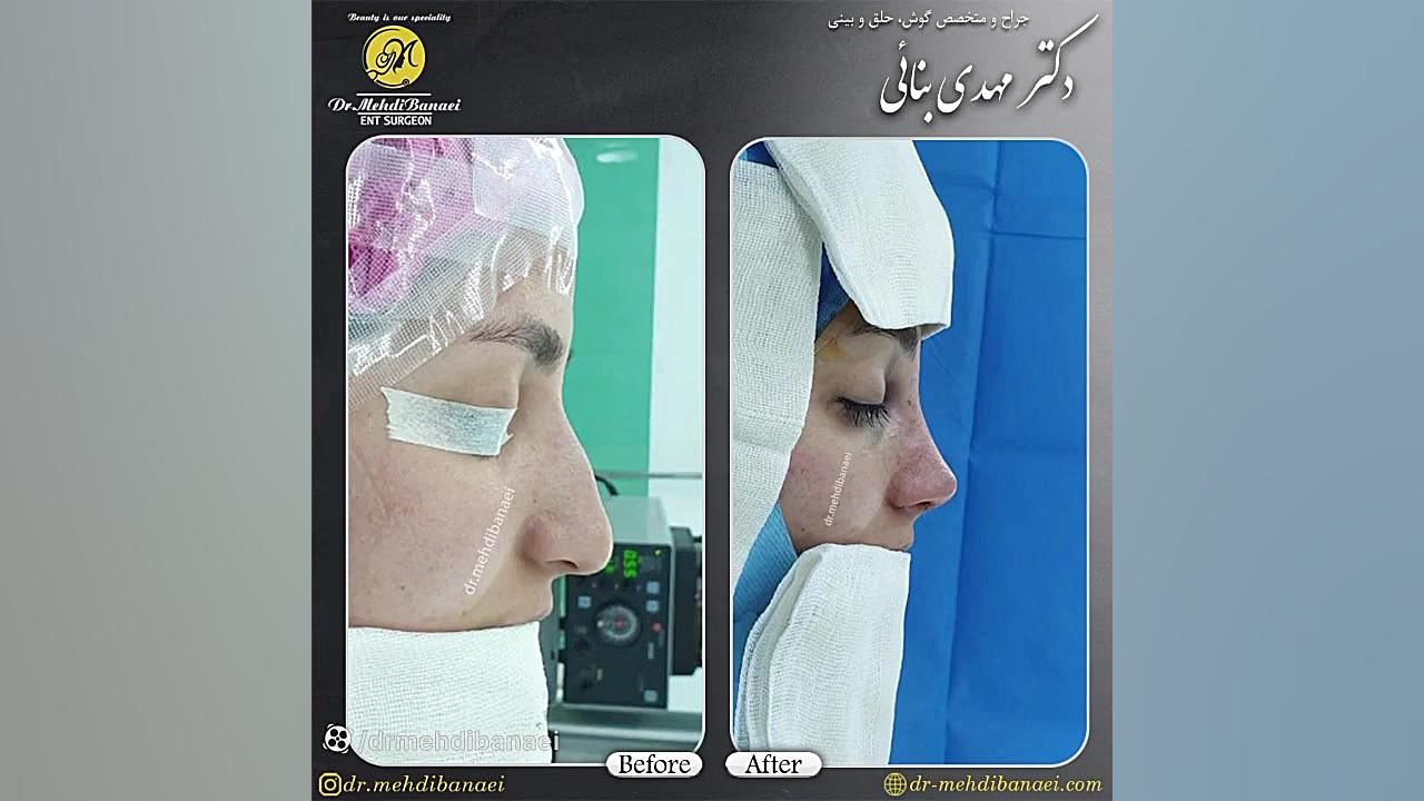 جراحی بینی طبیعی