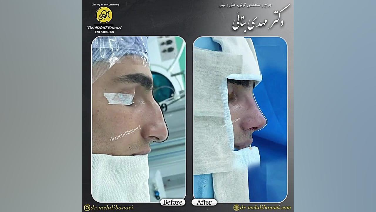 جراحی بینی قوزدار با افتادگی شدید نوک بینی