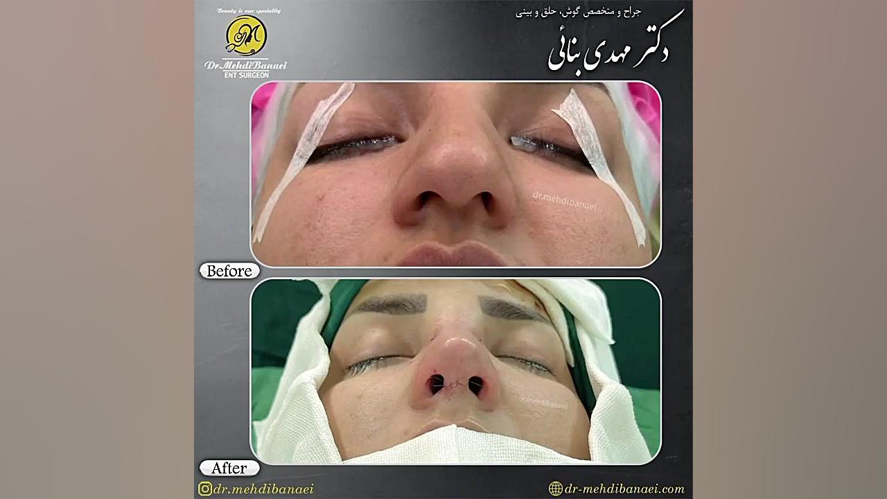 جراحی بینی گوشتی با افتادگی نوک بینی