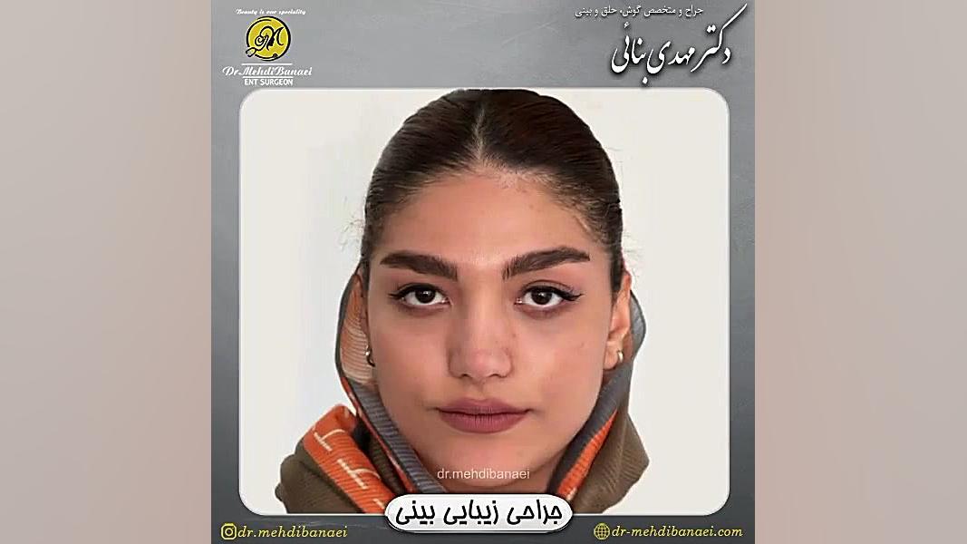 جراحی زیبایی بینی