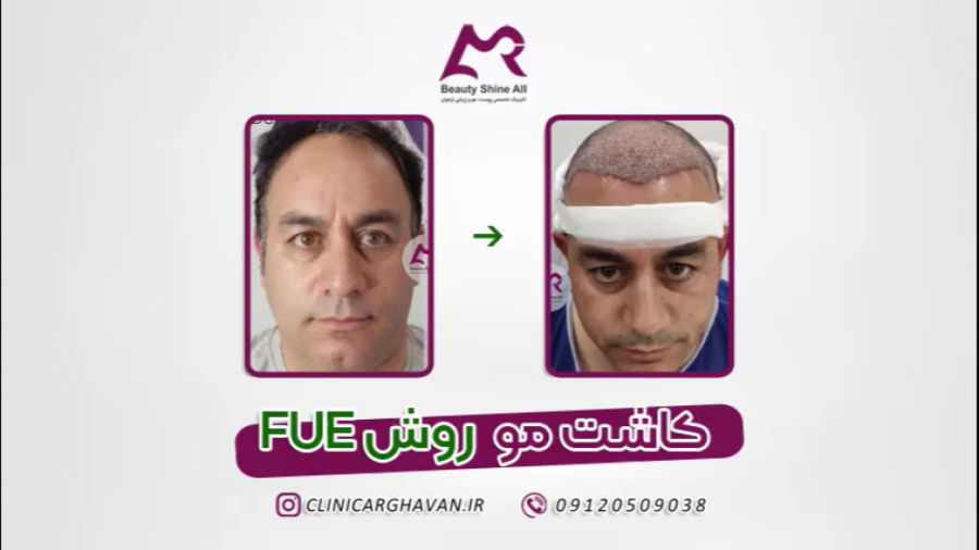کاشت مو به روش SUPER FUE - کلینیک کاشت مو ارغوان نقص اسیدهای چرب زنجیره متوسط