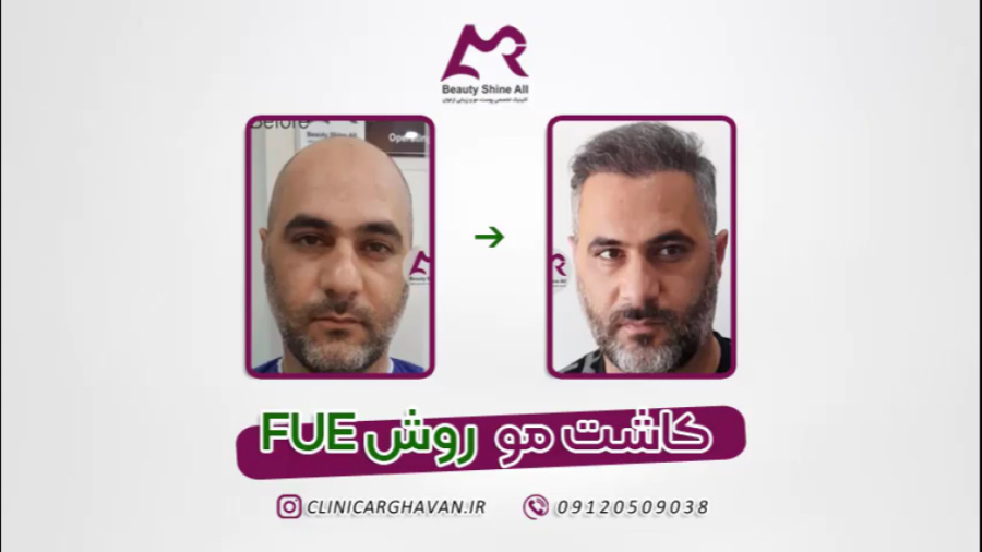 کاشت مو به روش SFUE - کلینیک کاشت مو ارغوان پیلینگ شیمیایی
