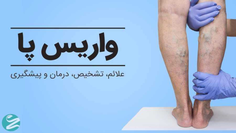 درمان واریس پا در طب سنتی پر کردن دندان