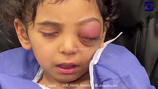 عوارض سینوزیت به دنبال آنفولانزا در کاسه چشم کودک سه ساله درمان جای جوش