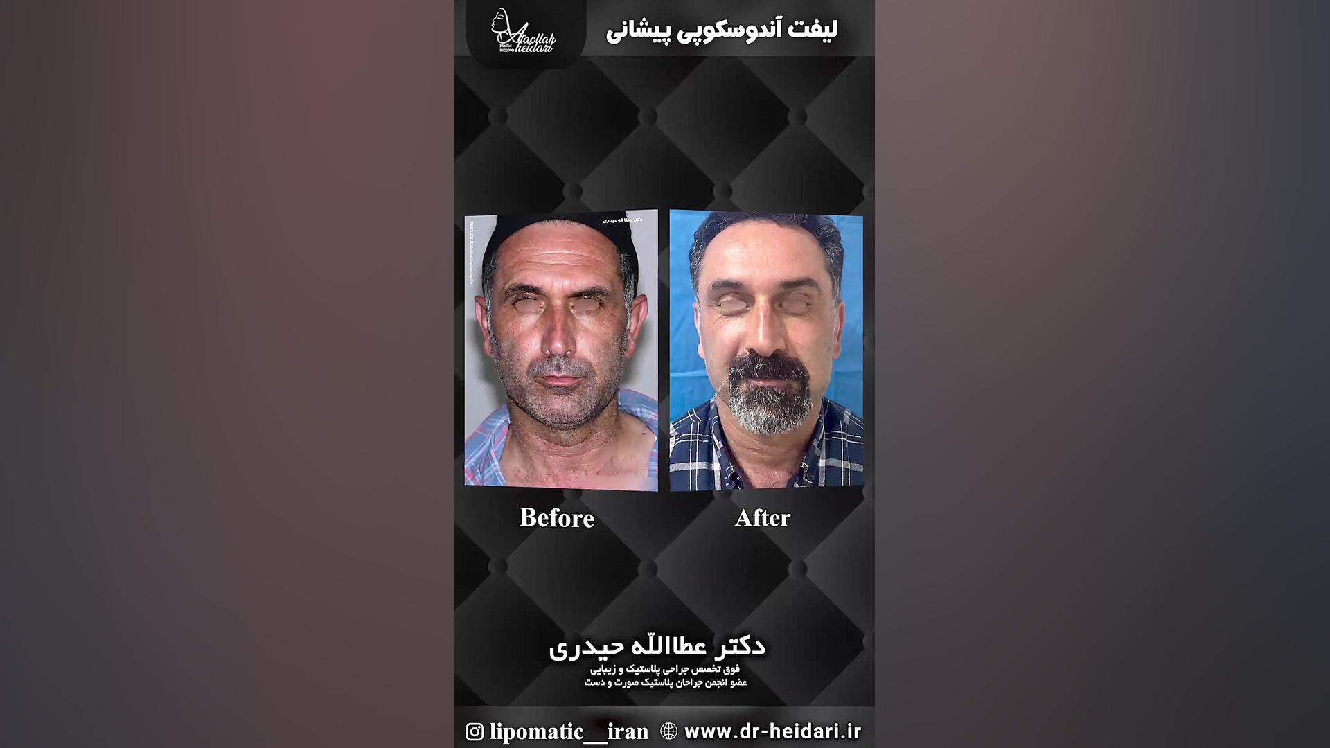 لیفت آندوسکوپی پیشانی تست تراشه ژنی