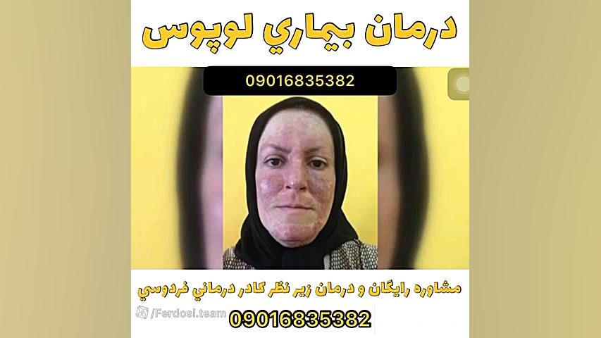 چگونه لوپوس را درمان کنیم؟ عمل زیبایی