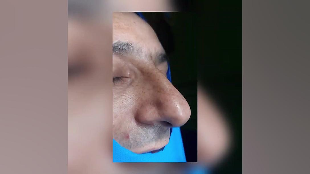 عمل بینی آقایون دکتر مهرابی شیراز دکتر محمد مهدی مهرابی جراح پلاستیک و زیبایی