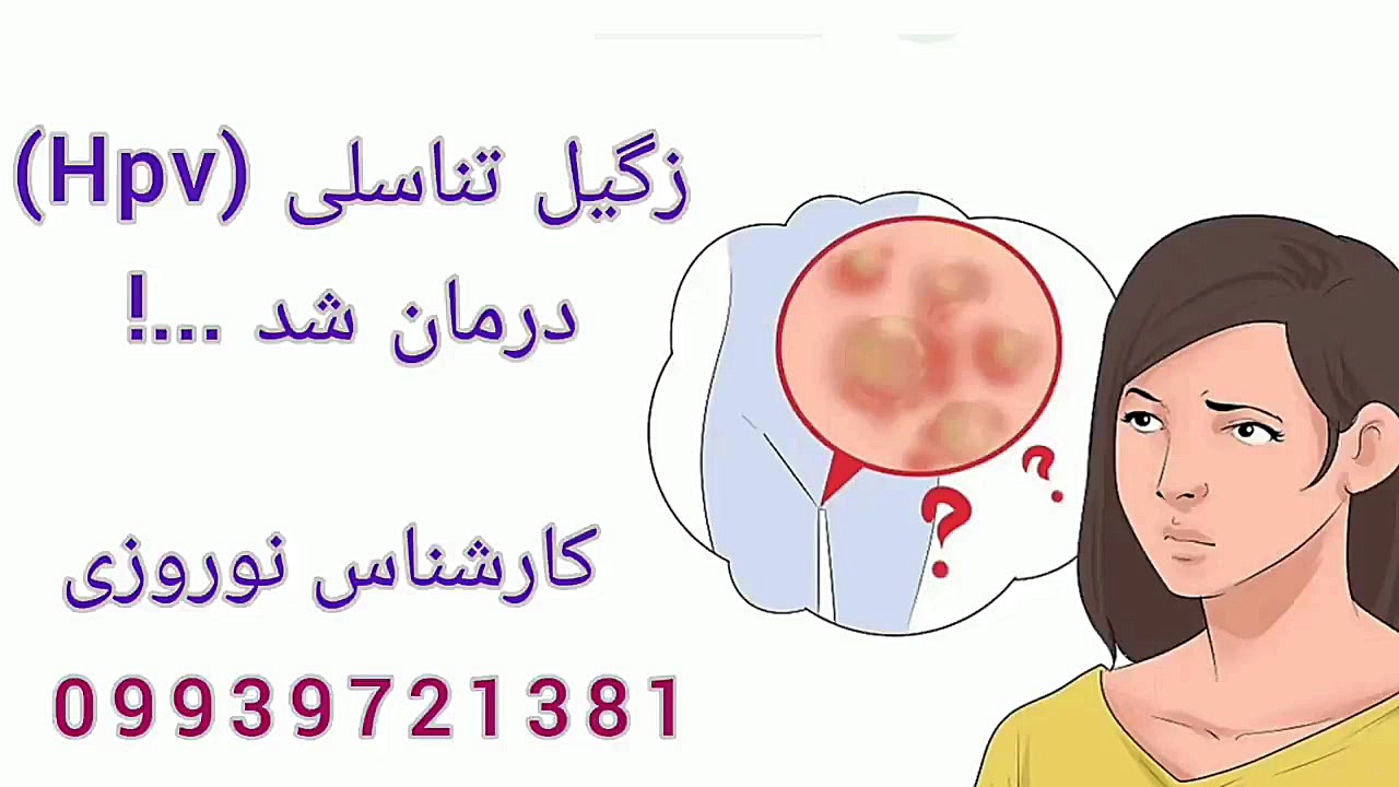 زگیل تناسلی در زنان چالش موزیکال