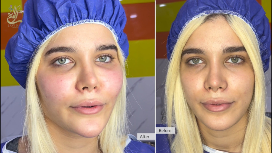 تزریق چربی صورت جراحی فک