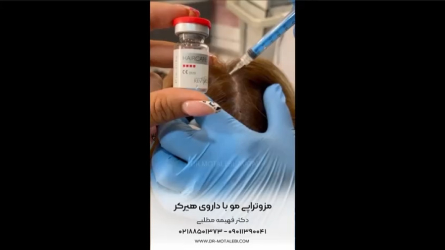 مزوتراپی موی سر با هیرکر سینتولاژوماب