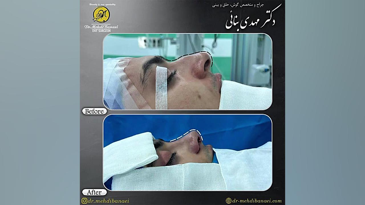 جراحی بینی قوزدار با پره های بزرگ