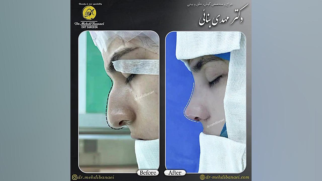 جراحی بینی قوزدار با افتادگی نوک بینی