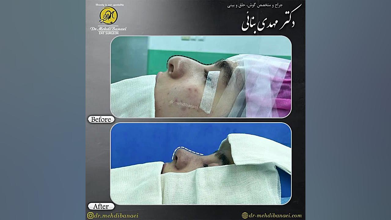 قبل و بعد از جراحی زیبایی بینی