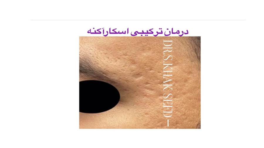 درمان ترکیبی اسکار آکنه-دکتر خاک سفیدی جراحی پف زیر چشم