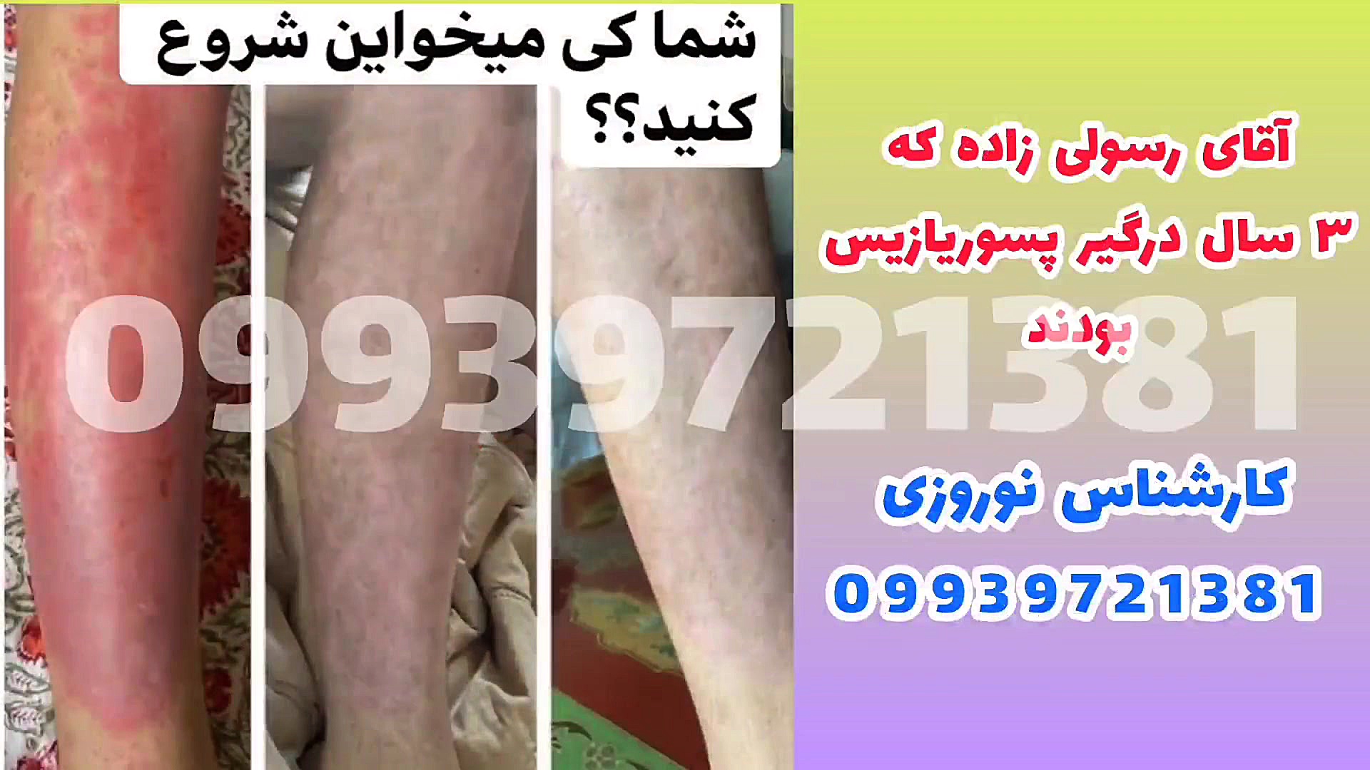 درمان خانگی پسوریازیس پسر آبجی