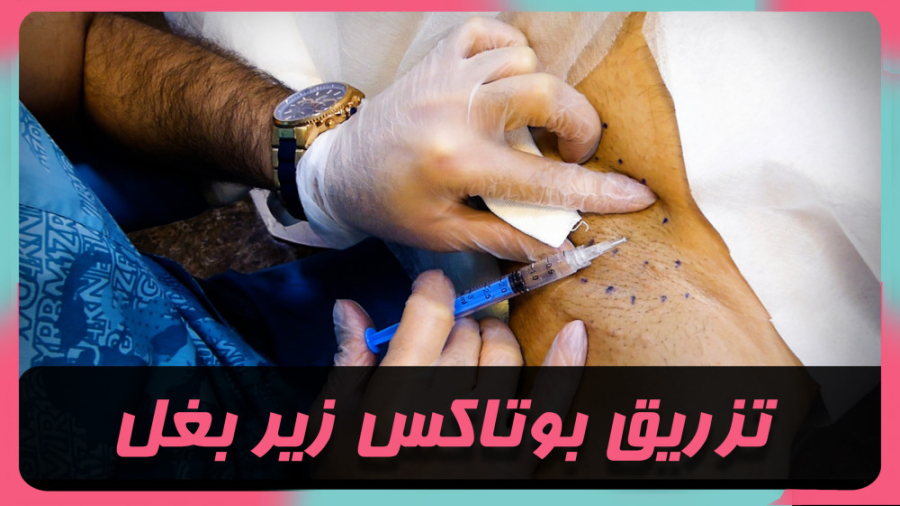 درمان تعریق بیش از حد با بوتاکس زیر بغل اکستنشن تاج دندان