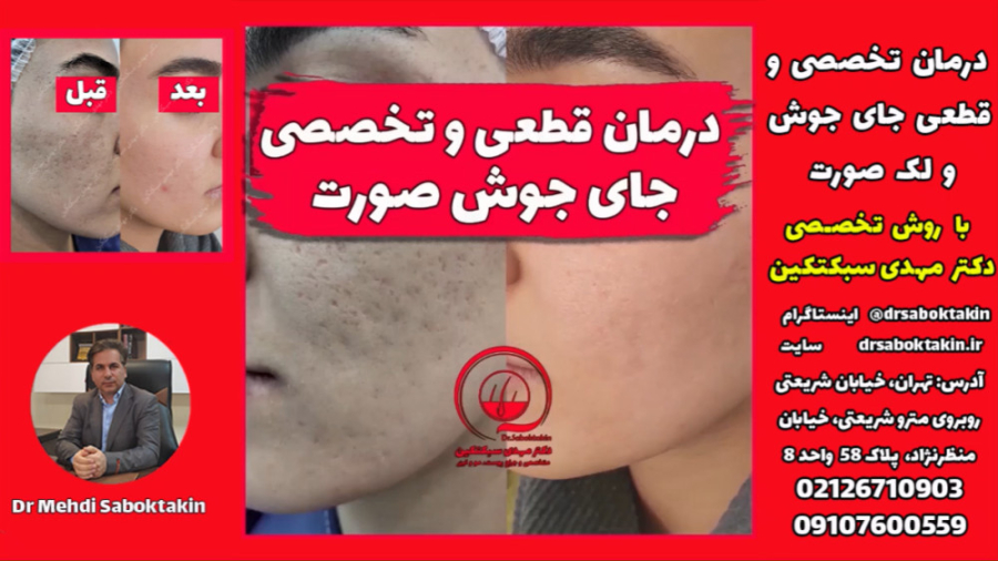 لیزر جای جوش - درمان جای جوش (اسکار آکنه) و لک های صورت - از بین بردن جای جوش کاشت مو