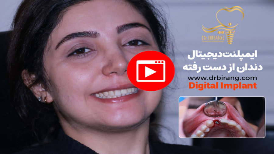 ایمپلنت دیجیتال دندان از دست رفته بر اثر ضربه | دکتر احسان بیرنگ متخصص ایمپلنت دکتر احسان بیرنگ