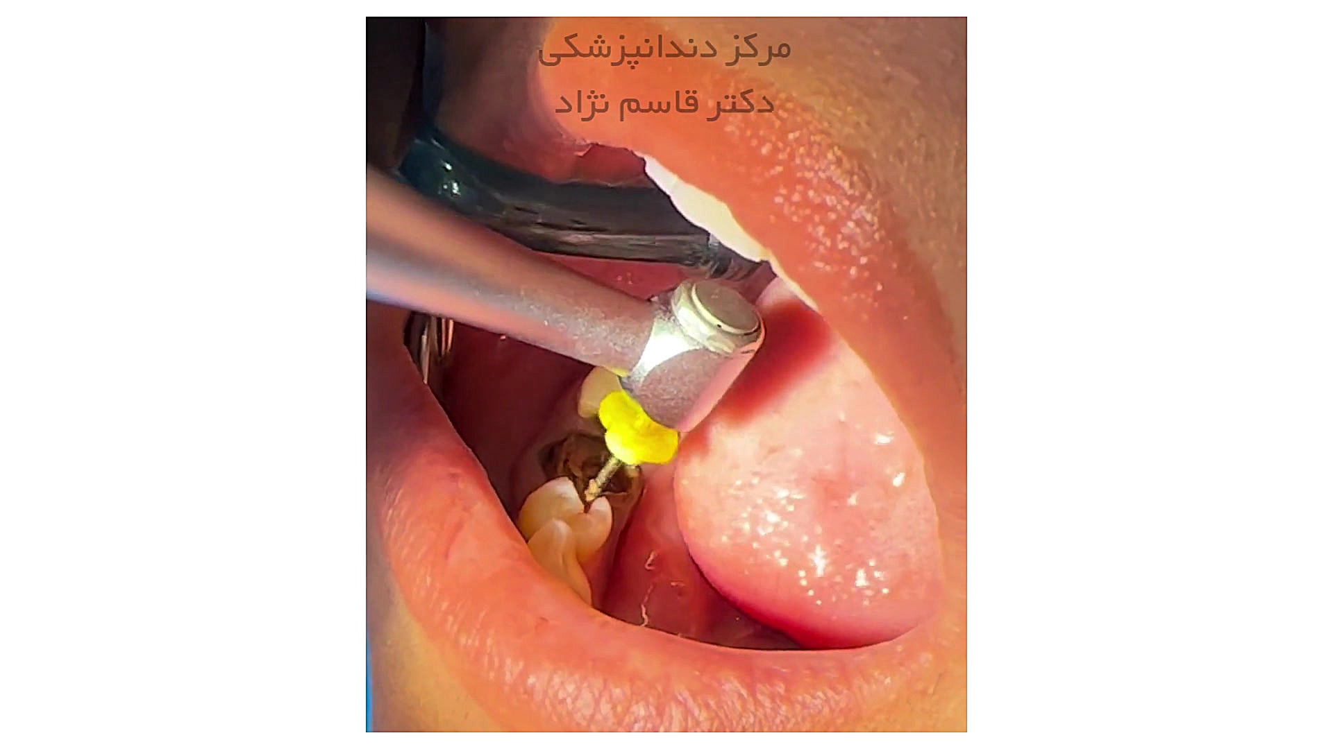 فیلم عصب کشی با دستگاه روتاری ریتوکسیمب-هایبرید