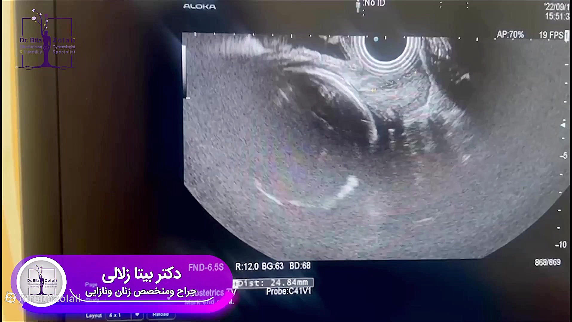 یکی از علائم مهم زایمان زودرس تزریق چربی